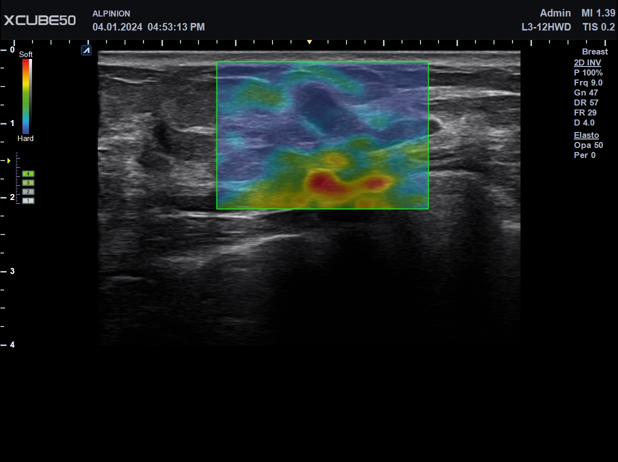 Breast_Strain Elastography