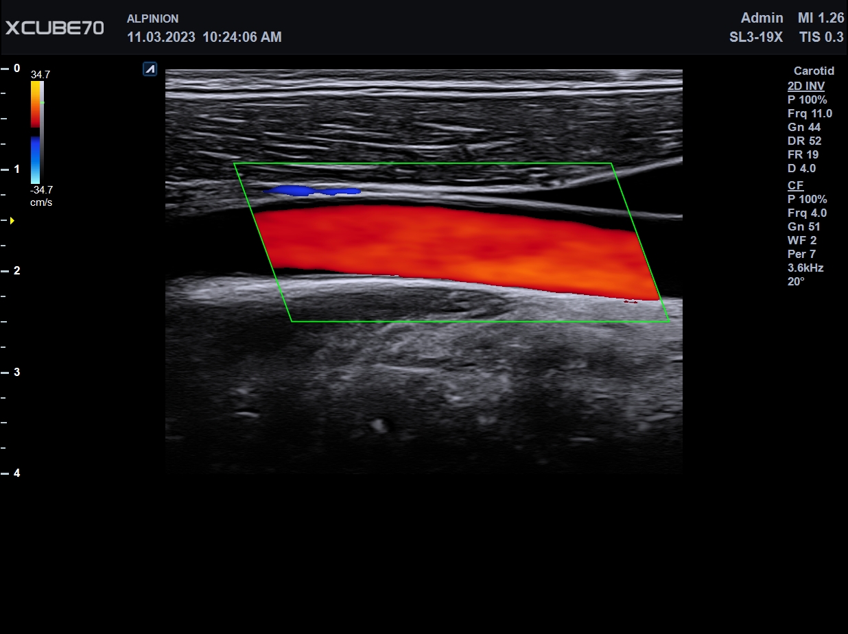 Carotid 03