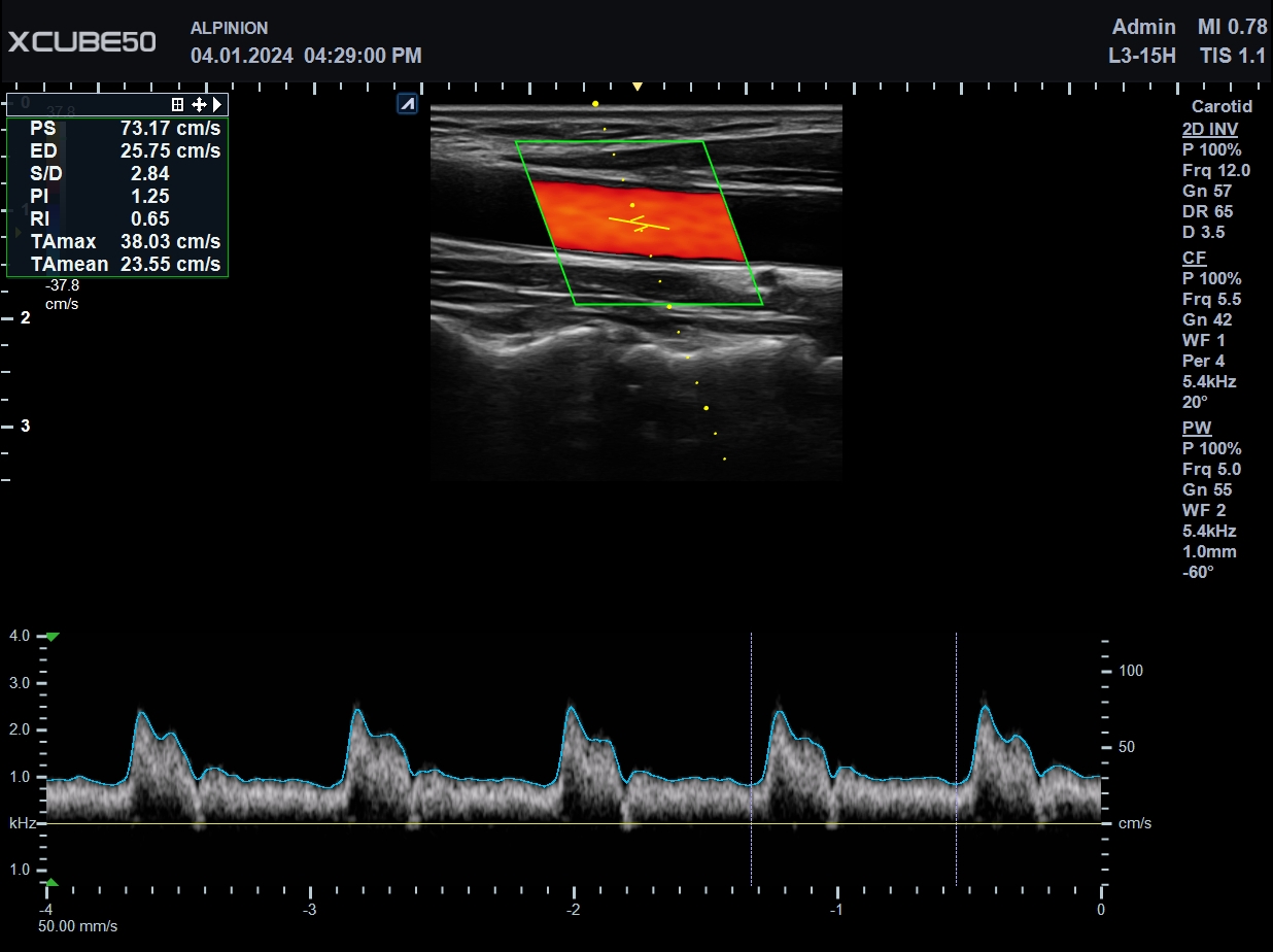 Carotid PW
