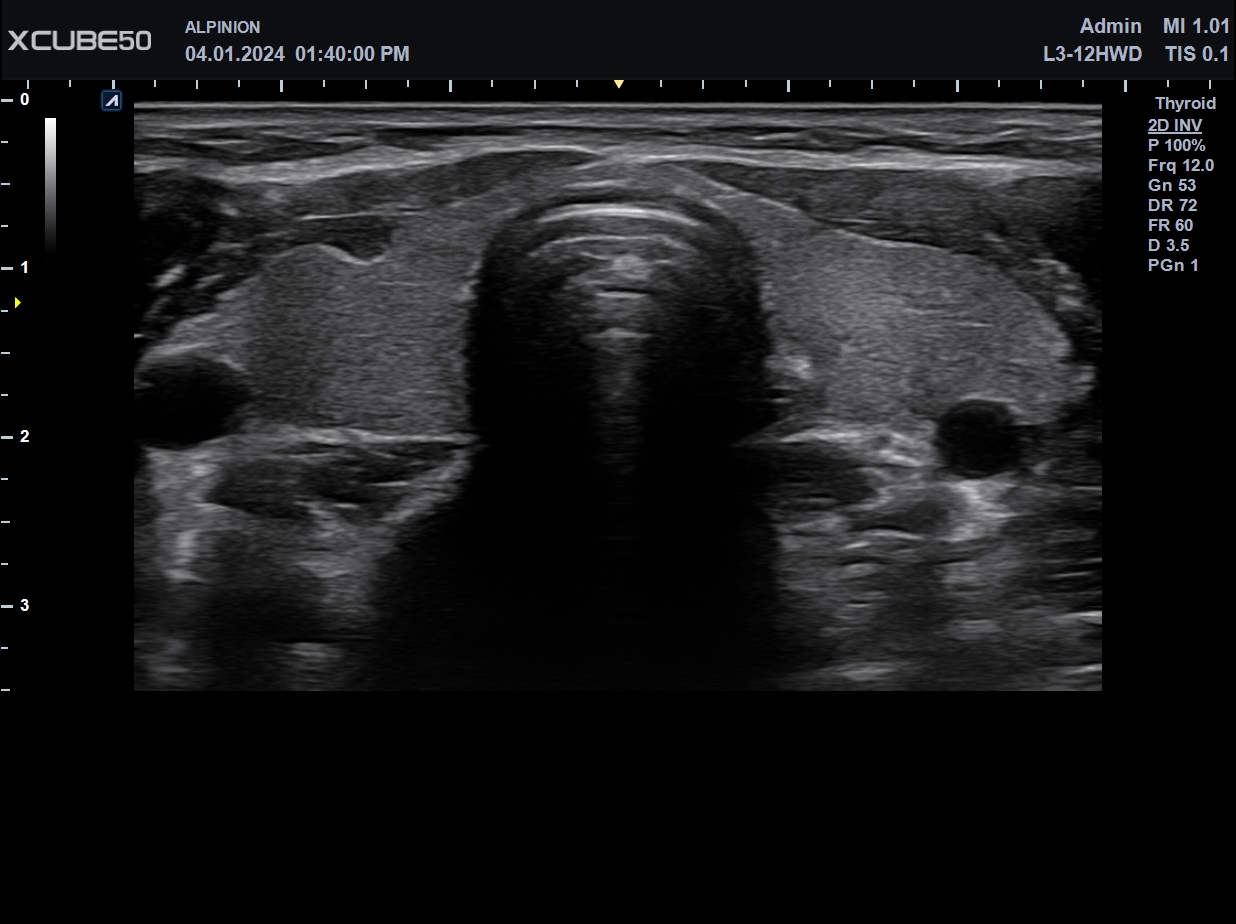XC50_Thyroid